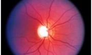Glaucoma, segunda causa de ceguera en el mundo
