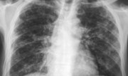 Tuberculosis, problema de salud en Argentina