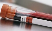 Examen de sangre, prometedor para detectar cáncer de pulmón
