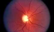 Día Mundial del Glaucoma: ¿Cómo saber si estamos en riesgo y cómo prevenirlo?