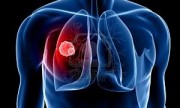 Mutación genética aumenta el riesgo de cáncer de pulmón